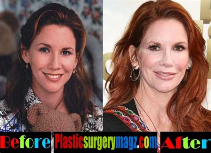 Melissa Gilbert’s Plastic Surgery: Botox, Breast Implants & More!