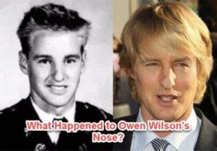 
What Happened To Owen Wilson’s Nose? The Truth Revealed 
